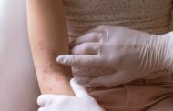 Qué es la dermatomiositis juvenil y cómo afecta a los niños y adolescentes
