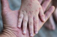 Colombia refuerza vigilancia ante declaratoria de emergencia internacional por mpox clado