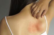 Cómo podemos prevenir enfermedades virales como la culebrilla