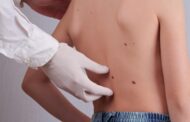 ¿Por qué algunos niños tienen verrugas? ¿Cuándo debemos preocuparnos?
