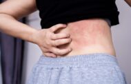 Urticaria crónica: síntomas, causas y soluciones para mejorar tu calidad de vida
