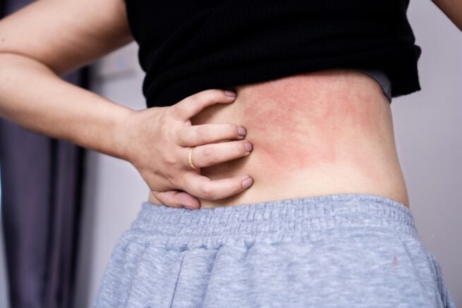 Urticaria crónica: síntomas, causas y soluciones para mejorar tu calidad de vida