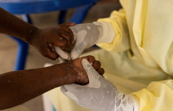 Sierra Leona declara emergencia después de confirmar segundo caso de viruela símica en 4 días