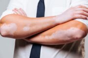 Día Mundial del Vitiligo; afecta el 2 % de la población mundial
