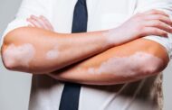 Día Mundial del Vitiligo; afecta el 2 % de la población mundial