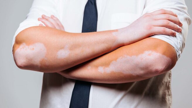Día Mundial del Vitiligo; afecta el 2 % de la población mundial
