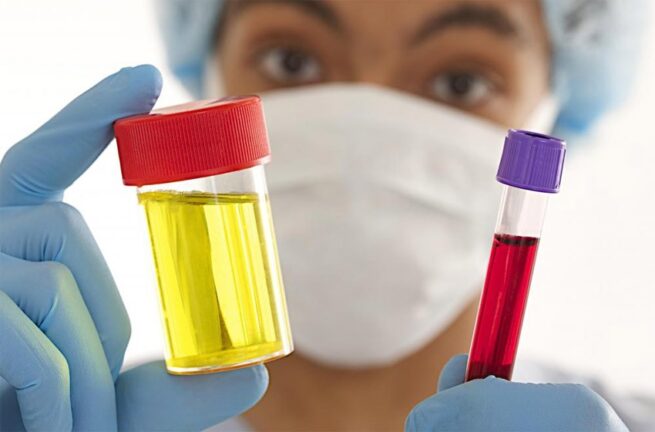 ¿Por qué aparece sangre en la orina? Estas son las causas de la hematuria, según un especialista