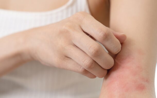 Dermatitis Atópica, una de las enfermedades no contagiosas de la piel más frecuentes