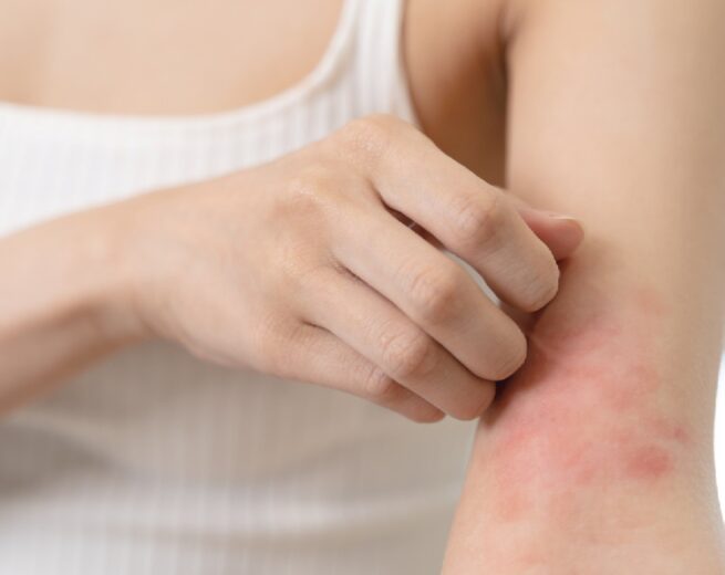 Dermatitis Atópica, una de las enfermedades no contagiosas de la piel más frecuentes