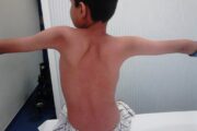 Distrofia Muscular de Cintura, una enfermedad que afecta a miles de personas