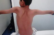 Distrofia Muscular de Cintura, una enfermedad que afecta a miles de personas