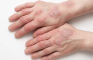 Los efectos psicológicos y físicos que sufren los pacientes afectados por la psoriasis