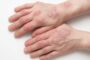 Los efectos psicológicos y físicos que sufren los pacientes afectados por la psoriasis
