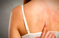La Urticaria Crónica afecta a un 20 % de la población mundial