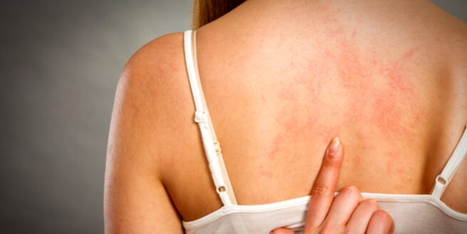 La Urticaria Crónica afecta a un 20 % de la población mundial
